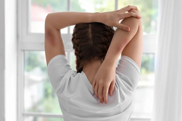 Sporty Young Woman Bruised Arms Gym Back View — Stock Photo, Image
