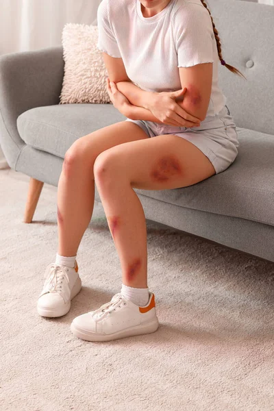 Young Woman Bruises Sitting Sofa Home — Stock Photo, Image