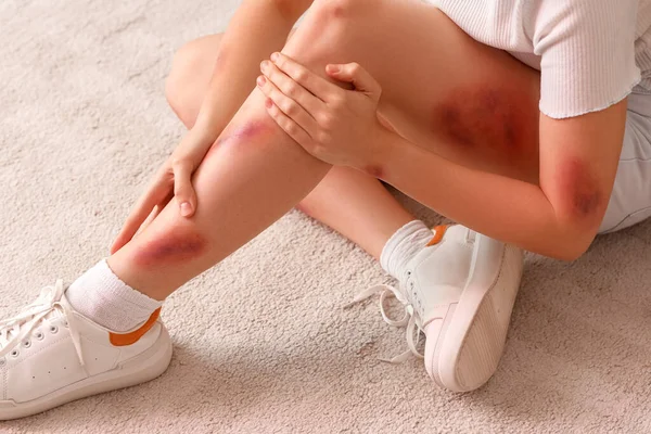 Young Woman Bruises Sitting Floor Home Closeup — Stock Photo, Image