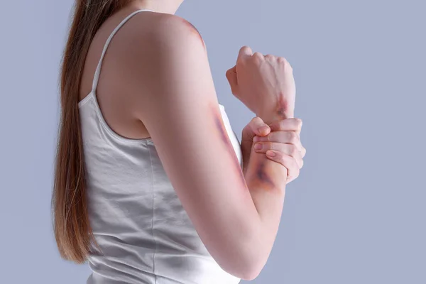 Νεαρή Γυναίκα Μελανιασμένο Χέρι Γκρι Φόντο Κοντινό Πλάνο — Φωτογραφία Αρχείου