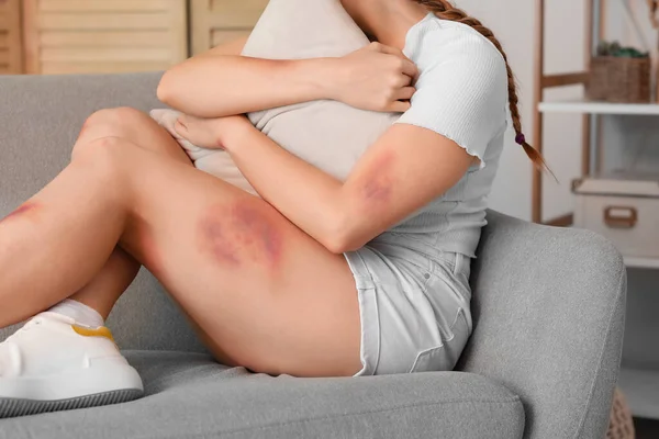 Young Woman Bruises Sitting Sofa Home — Stock Photo, Image
