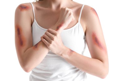 Kolları morarmış, beyaz arka planda genç bir kadın, yakın plan.