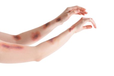 Beyaz arka planda çürük kadın elleri