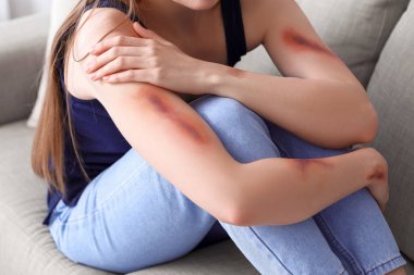 Young woman with bruised arms sitting on sofa at home, closeup clipart