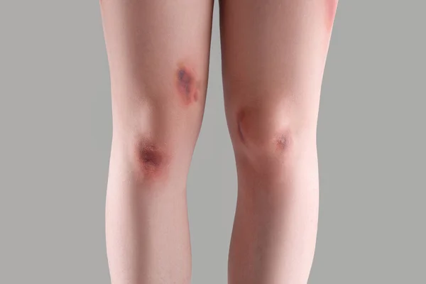 グレーの背景に脚を負傷した若い女性 クローズアップ — ストック写真