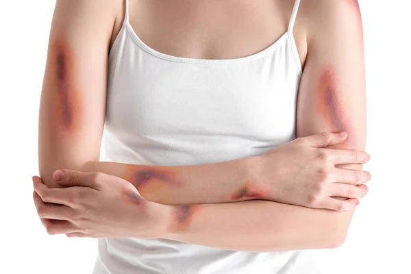 Young Woman Bruised Arms White Background Closeup — Stock Photo, Image