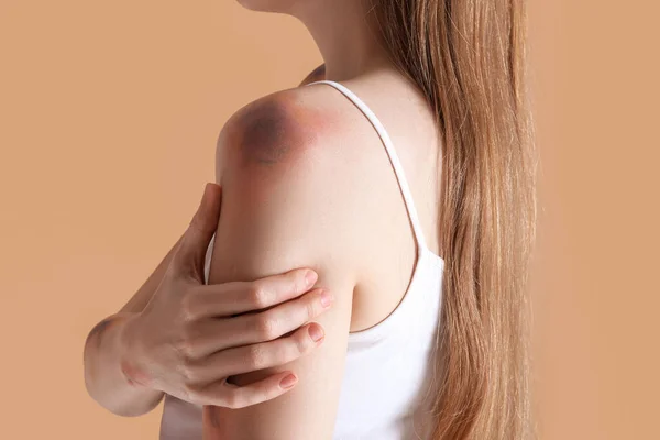 Young Woman Bruised Shoulder Beige Background Closeup — Stock Photo, Image