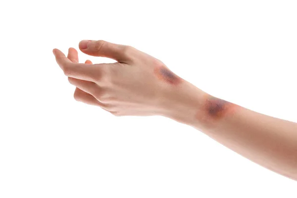 Синяки Женской Руки Белом Фоне — стоковое фото