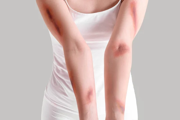 灰色の背景に腕を負傷した若い女性 クローズアップ — ストック写真