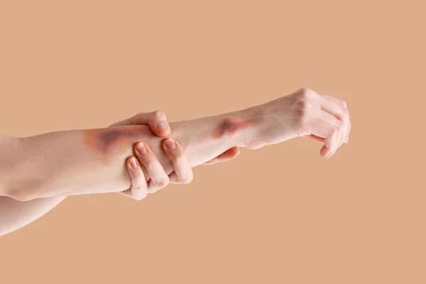Pohmožděné Ženské Ruce Béžovém Pozadí — Stock fotografie