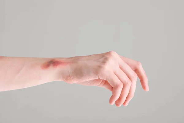 Μελανιασμένο Γυναικείο Χέρι Γκρι Φόντο — Φωτογραφία Αρχείου