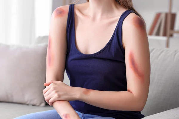 Young Woman Bruised Arms Sitting Sofa Home Closeup — Stock Photo, Image