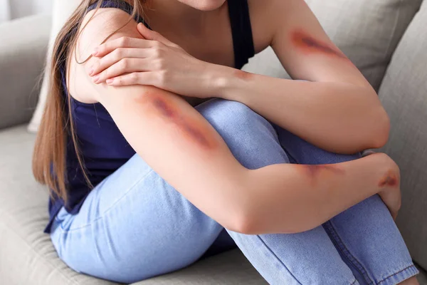 Young Woman Bruised Arms Sitting Sofa Home Closeup — Stock Photo, Image