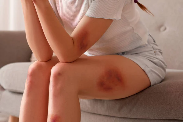 Young Woman Bruises Sitting Sofa Home Closeup — Stock Photo, Image