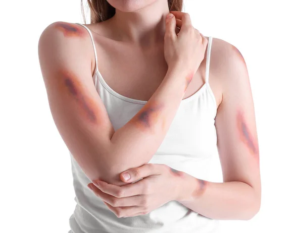 年轻女子 手臂受伤 背景为白色 特写镜头 — 图库照片