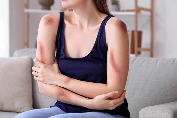 Young Woman Bruised Arms Sitting Sofa Home — Stock Photo, Image
