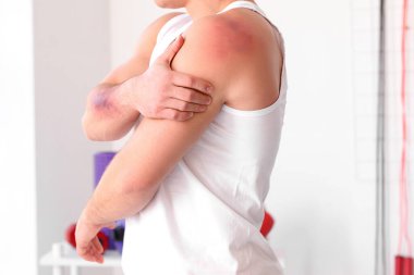 Spor salonunda vücudunda çürükler olan sporcu bir adam.