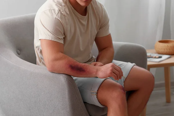 Man Bruise Arm Home — Stock Photo, Image