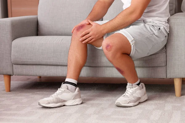 Man Bruises His Legs Sitting Sofa Home — Stock Photo, Image