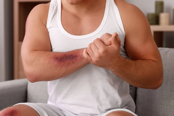 Man Bruises His Body Home — Stock Photo, Image