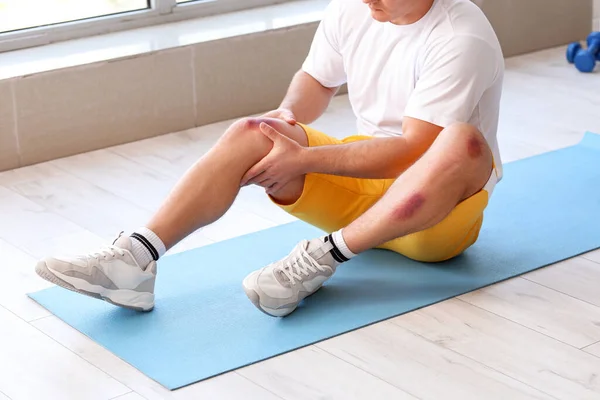 Sporty Man Bruises Body Training Gym — Stock Photo, Image