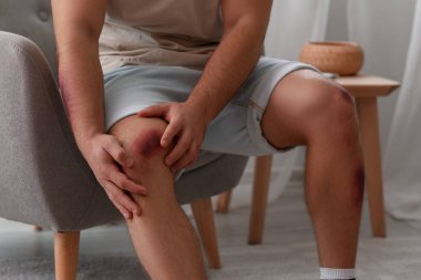 Evinde vücudunda çürükler olan bir adam.