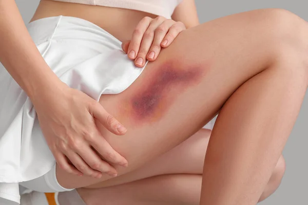 Junge Frau Mit Gebrochenem Bein Auf Grauem Hintergrund Nahaufnahme — Stockfoto