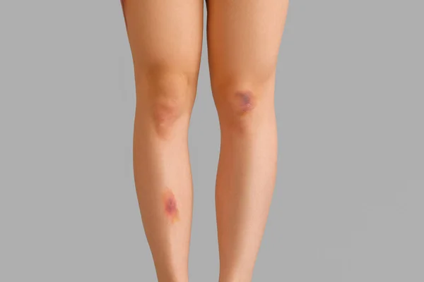 Gri Arka Planda Yaralı Bacakları Olan Genç Bir Kadın Yakın — Stok fotoğraf