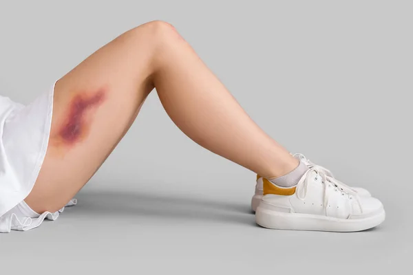 Junge Frau Mit Gebrochenem Bein Auf Grauem Hintergrund — Stockfoto