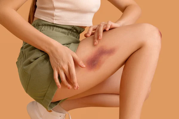 Young Woman Bruised Leg Beige Background Closeup — Stock Photo, Image
