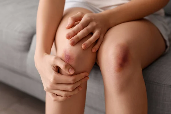 Young Woman Bruised Legs Sitting Sofa Home Closeup — Stock Photo, Image
