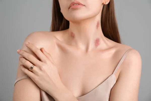 Junge Frau Mit Liebesbissen Hals Vor Grauem Hintergrund Nahaufnahme — Stockfoto