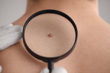Dermatolog, klinikte büyüteçle genç adamın sırtındaki beni inceliyor.