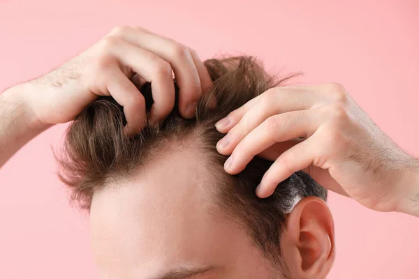 Mladý Muž Problémem Vypadávání Vlasů Růžovém Pozadí Detailní Záběr — Stock fotografie