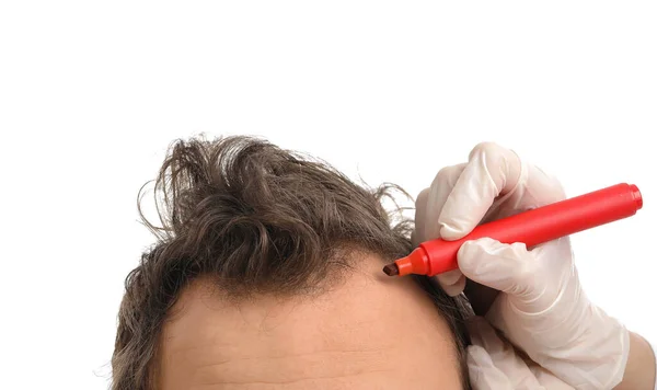 Arzt Markiert Stirn Des Jungen Mannes Mit Haarausfall Problem Auf — Stockfoto