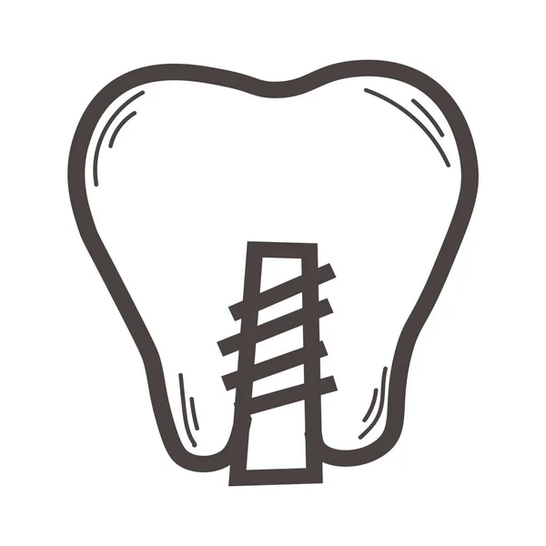 Tooth Implant White Background — Stockvektor