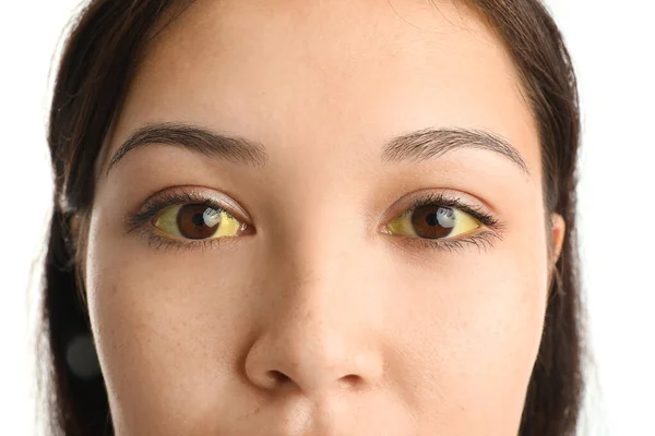 Young Woman Yellow Eyes Closeup Hepatitis Symptom — стоковое фото