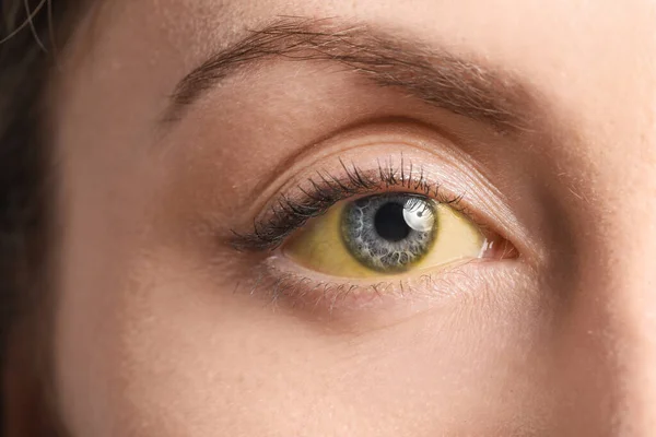 Jovem Com Olhos Amarelos Close Sintoma Hepatite — Fotografia de Stock