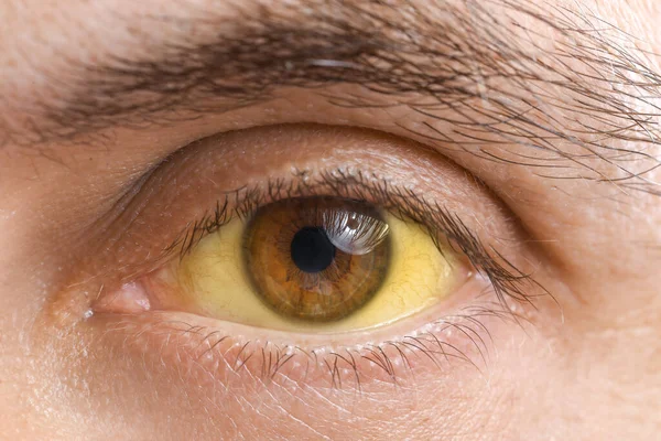 Homem Olhos Amarelos Perto Sintoma Hepatite — Fotografia de Stock