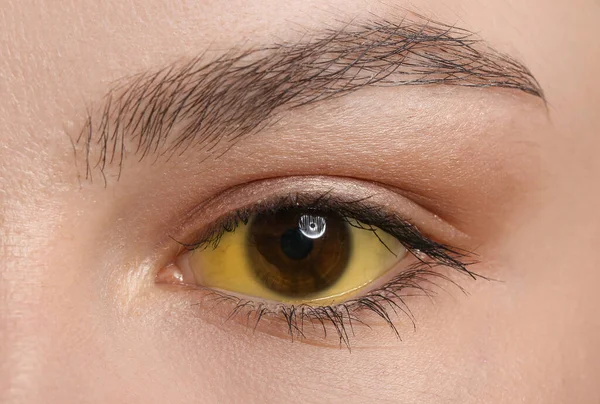Young Woman Yellow Eyes Closeup Hepatitis Symptom — Fotografia de Stock