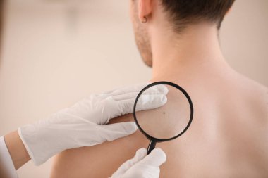 Dermatolog, klinikte büyüteçle genç adamın sırtındaki beni inceliyor.