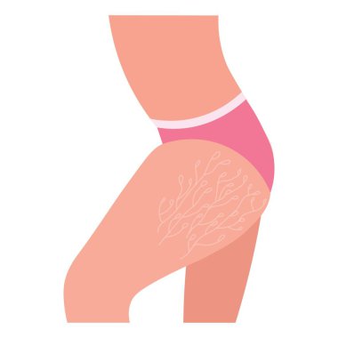 Kalçasında beyaz arka planda gerilme izleri olan kadın.