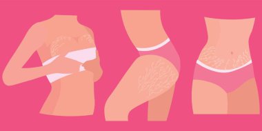 Women with stretch marks on their bodies against pink background clipart