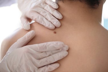Dermatolog klinikte genç adamın sırtındaki beni inceliyor.