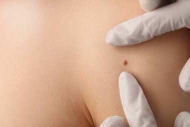 Dermatolog, genç adamın omzundaki beni inceliyor, yakın plan.