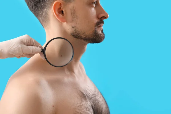 Dermatologo Esaminando Talpa Giovane Uomo Con Lente Ingrandimento Sfondo Blu — Foto Stock