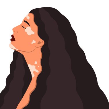 Beyaz arka planda vitiligo olan güzel bir kadın.