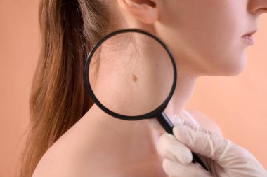 Dermatolog, genç kadının benini bej arka planda büyüteçle inceliyor.