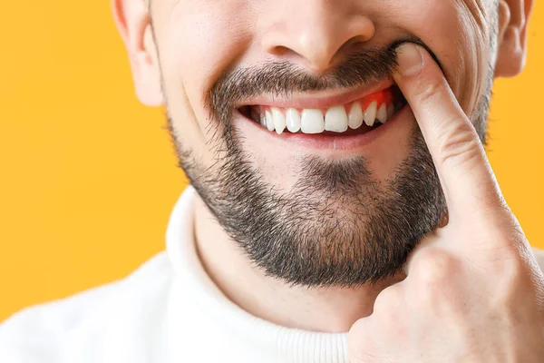 Mann Mit Zahnfleischentzündung Auf Gelbem Hintergrund Nahaufnahme — Stockfoto