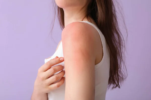 Allergic Young Woman Sunburned Skin Lilac Background Closeup — Stock Photo, Image